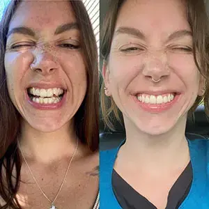 Invisalign before and after adult woman