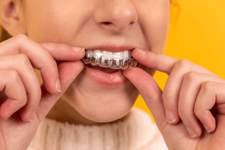 Understanding How Teeth Move with Aligners