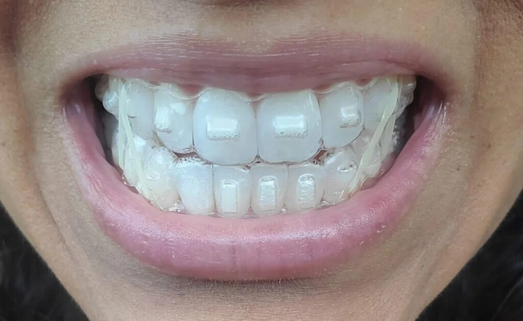 What Are Invisalign Attachments? When Are They Necessary? 2 What are Invisalign Attachments