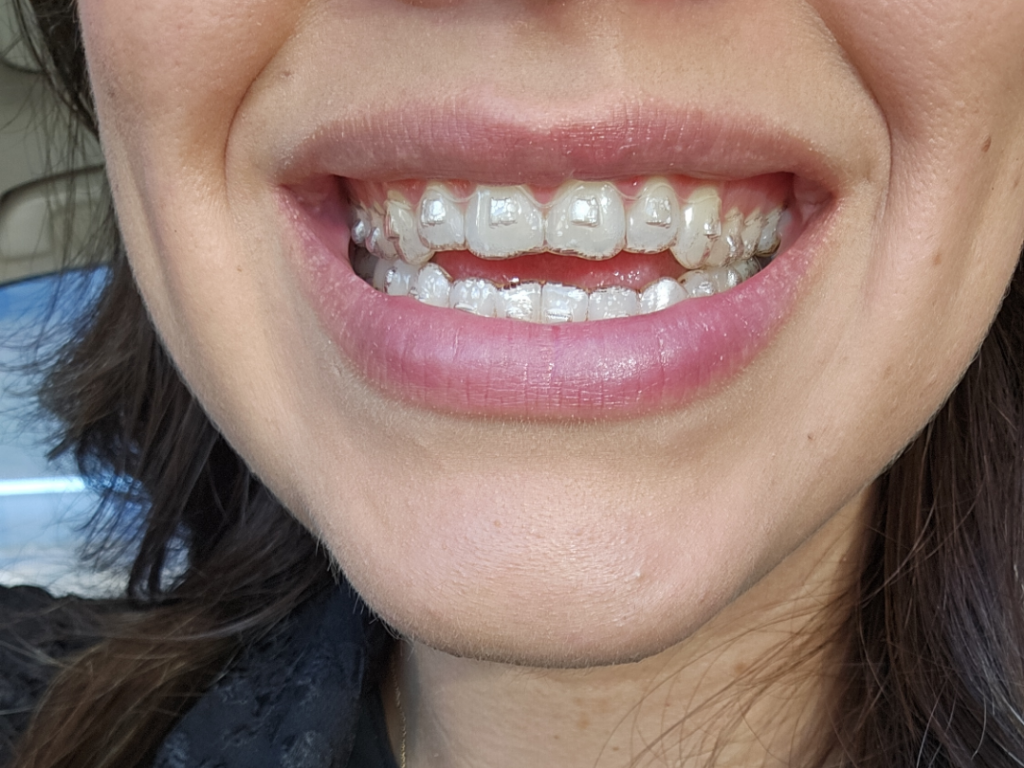 What Are Invisalign Attachments? When Are They Necessary? 1 Who Needs Invisalign Attachments